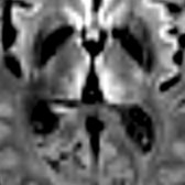 Axial DWI MR in a patient with variant CJD (vCJD) demonstrates diffusion restriction in bilateral posteromedial aspect of thalami  representing hockey stick sign.