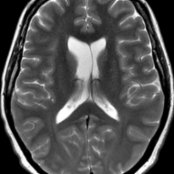 Axial T2 MR demonstrates normal variant anatomy with mild asymmetric prominence of the right lateral ventricle  when compared to the left. Note the septum is slightly deviated to the left .