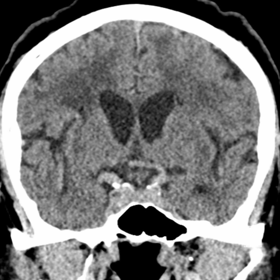 Coronal NECT shows ↑ density in the vascular structures compatible with physiologic hyperdensity.