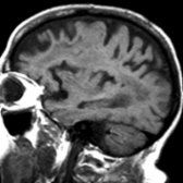 Sagittal T1WI MR demonstrates frontal cortical thinning with white matter hypointensity  from infarction. Also note the separate focus of white matter abnormality .