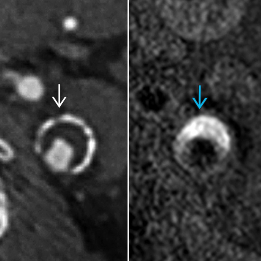 While IPH is best detected with MR and heavily T1-weighted sequences, such as MPRAGE , IPH can be inferred on CTA with a rim sign , which consists of a thin, < 2-mm rim of calcification with ≥ 2-mm central soft plaque. Likelihood of IPH increases with soft plaque thickness.