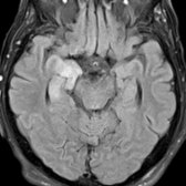 Axial FLAIR MR shows hyperintensity in the medial temporal lobes  in this patient with subacute dementia and voltage-gated potassium channel (VGKC) autoimmunity. VGKC may occur with or without a primary neoplasm and may have an LE pattern.