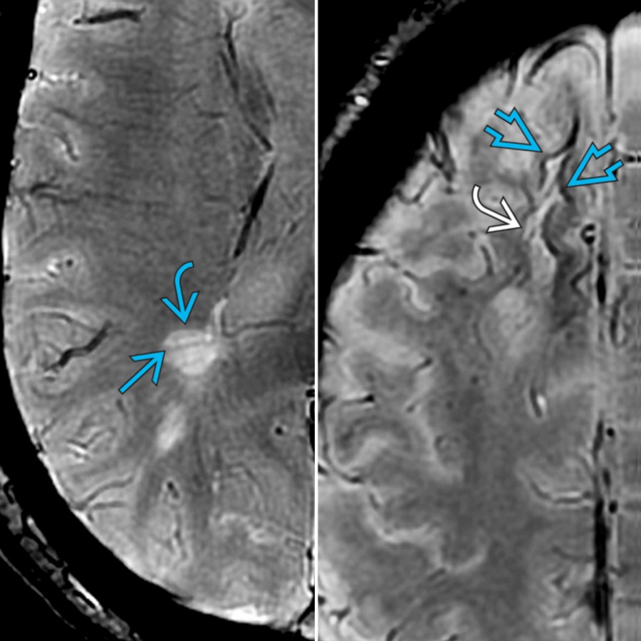 Axial SWI (R) demonstrates characteristic perivenular location of a demyelinating plaque  with the medullary vein  coursing through it. Axial SWI (L) in the same patient shows findings related to Natalizumab-associated PML   with juxtacortical hypointense rim .