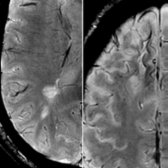 Axial SWI (R) demonstrates characteristic perivenular location of a demyelinating plaque  with the medullary vein  coursing through it. Axial SWI (L) in the same patient shows findings related to Natalizumab-associated PML   with juxtacortical hypointense rim .