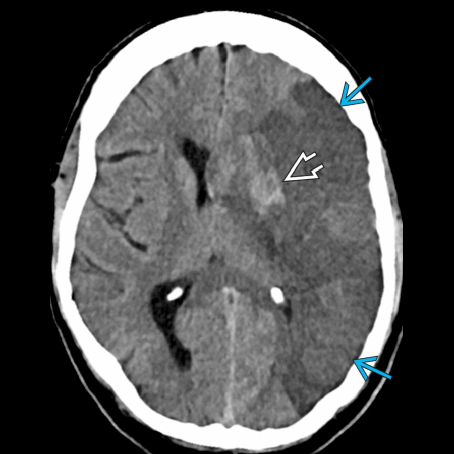 Axial NECT in the same patient 48 hours later shows a large left MCA distribution infarct  with hemorrhagic transformation . Infarct in the basal ganglia indicates involvement of lenticulostriate arteries, which typically arise from the proximal MCA.