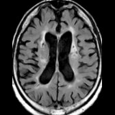 Axial FLAIR MR in a 72-year-old man with chronic hypertension and diabetes presenting with mood and behavioral changes shows confluent white matter hyperintensities  in the periventricular regions. Note the multiple chronic lacunar infarcts in the basal ganglia  as well as enlargement of the ventricles and cortical sulci.