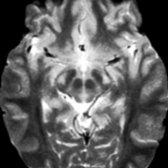Axial T2WI MR in the same patient with ALS shows symmetric hyperintense CSTs  at the level of the cerebral peduncle.