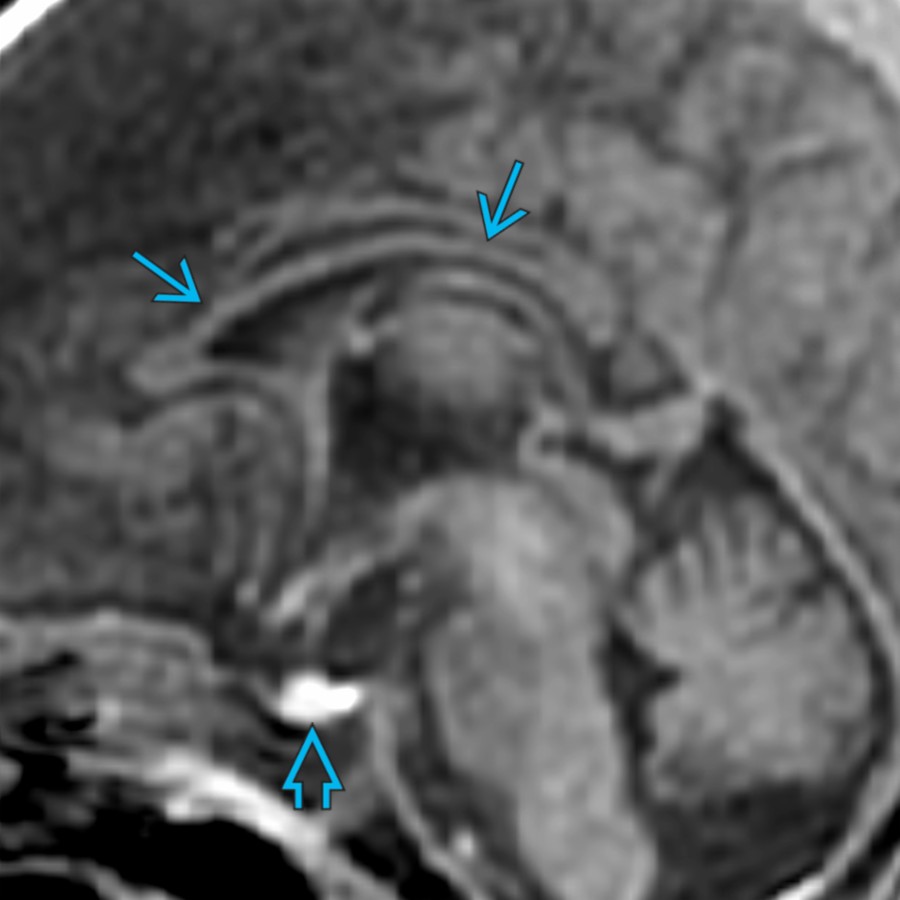 Midline sagittal T1 MR in a normal term neonate shows a thin, unmyelinated corpus callosum (CC) . The CC will gradually thicken as it myelinates from posterior to anterior. Note that the entire pituitary gland normally shows T1 shortening  in the 1st few weeks of life.