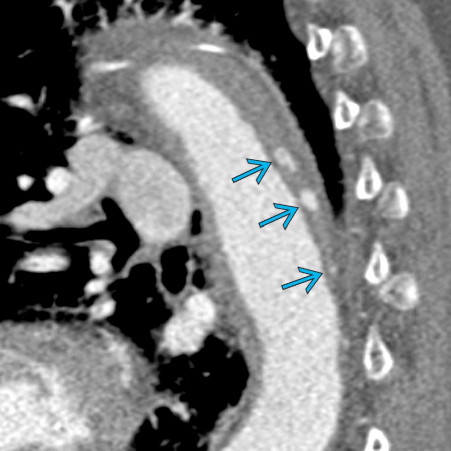 Sagittal oblique CTA in the same patient shows multilevel IBP  related to contiguous intercostal arteries. This appearance is often referred to as Chinese ring-sword sign. Overall, IBP (as opposed to ULP) can be closely observed with follow-up imaging (i.e., CTA), as they will typically resolve.