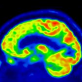Sagittal reformat of color-coded FDG PET in the same patient shows decreased metabolic activity in the frontal lobe . (Courtesy J. Singh, MD.)