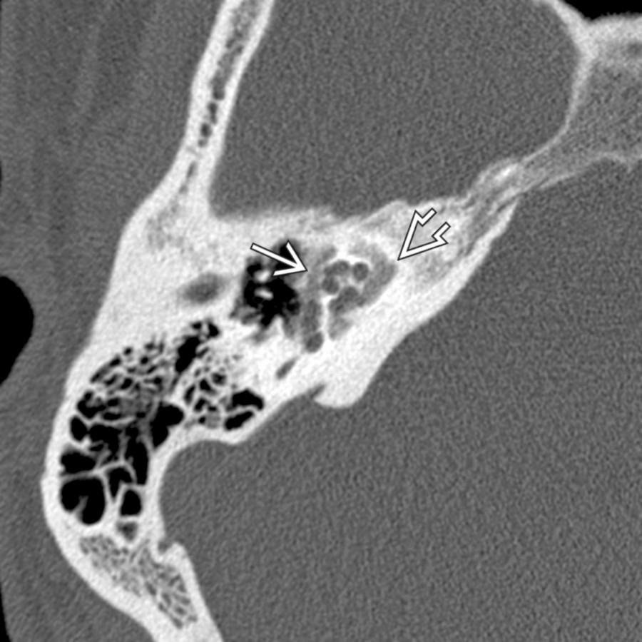 Axial bone CT shows severe otosclerosis as radiolucent foci along the medial middle ear wall  (fenestral otosclerosis) and within the bony labyrinth  (cochlear otosclerosis).
