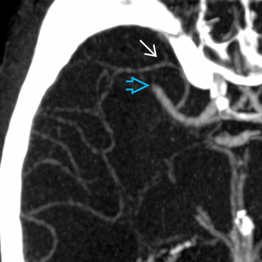Reformatted CTA shows occlusion of the right middle cerebral artery (MCA), M1 segment . The anterior temporal branch of the right MCA remains patent . The appearance is typical of an embolic occlusion.
