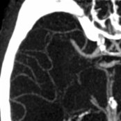 Reformatted CTA shows occlusion of the right middle cerebral artery (MCA), M1 segment . The anterior temporal branch of the right MCA remains patent . The appearance is typical of an embolic occlusion.