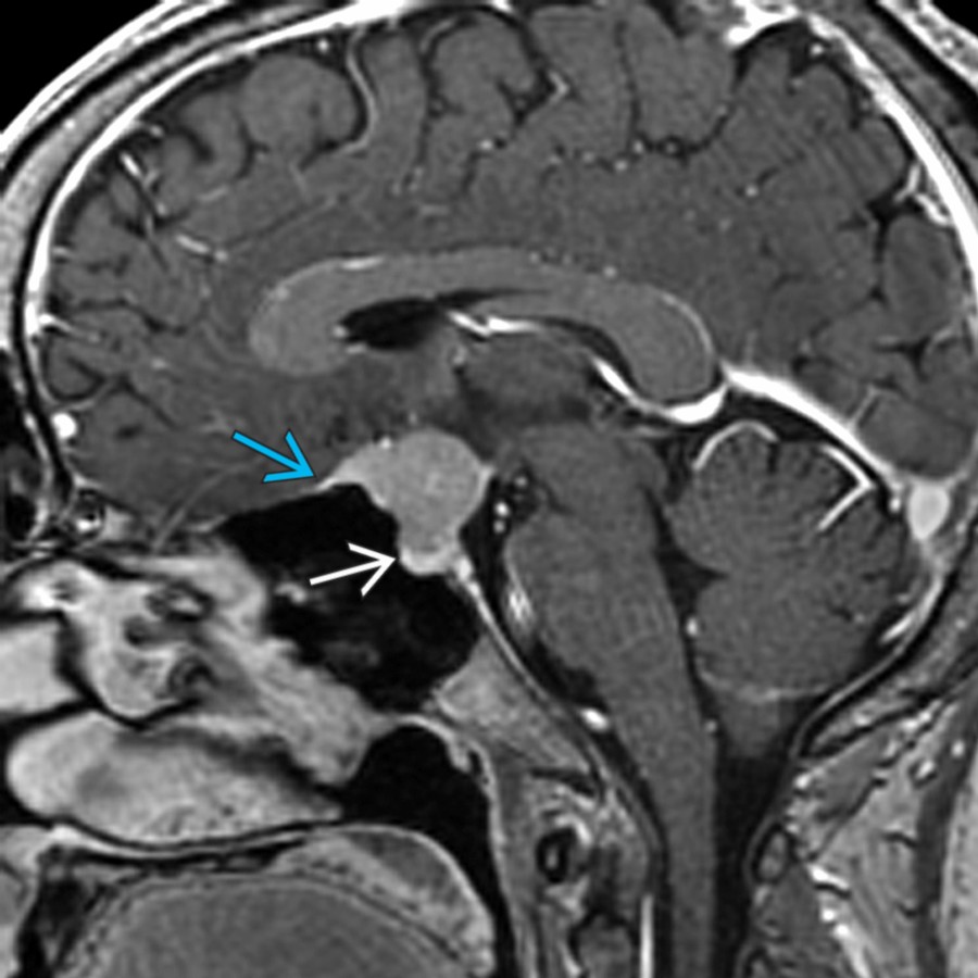 Sagittal T1 C+ FS MR shows an enhancing suprasellar meningioma with a dural tail  along the planum sphenoidale. Note the normal pituitary gland is seen inferiorly within the normal-sized sella turcica . The normal pituitary gland enhances brighter than the meningioma.