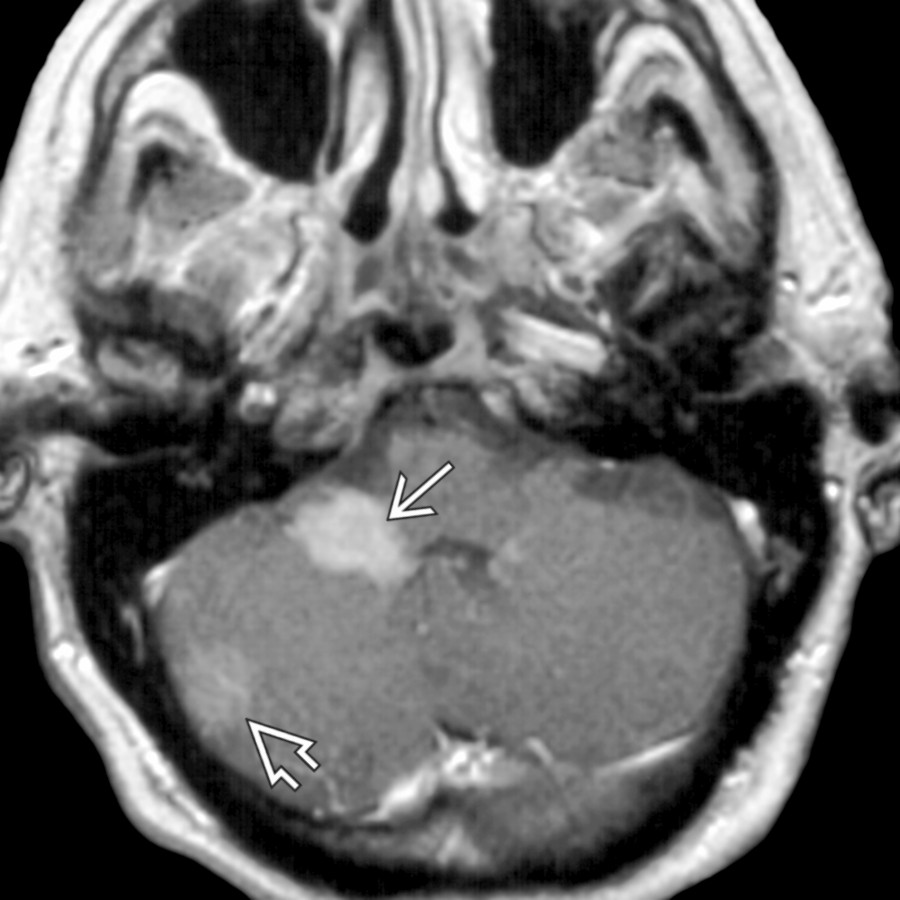 Axial T1WI C+ MR shows a typical case of primary CNS lymphoma with subependymal tumor spread. Note a posterior fossa mass near the foramen of Luschka  as well as a 2nd dural-based mass .