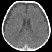 Axial NECT in a 9-week-old with seizures shows bilateral mixed attenuation subdural fluid collections with predominantly low attenuation anteriorly   & high attenuation posteriorly , consistent with a hematohygroma. This should not be described as "acute on chronic" subdural hemorrhage.