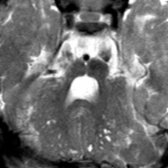 Axial T2 MR in a child with congenital muscular dystrophy shows multiple small,  cystic lesions in the dysplastic cerebellum . The pons is hypoplastic with dorsal clefting . Hypomyelination of the temporal lobes  is present.