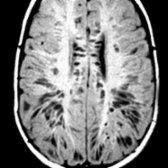 Axial T1 MR shows multiple enlarged perivascular spaces  in this young child with mucopolysaccharidoses 1H and minimal neurological symptoms. Note severe peritrigonal, callosal involvement.
