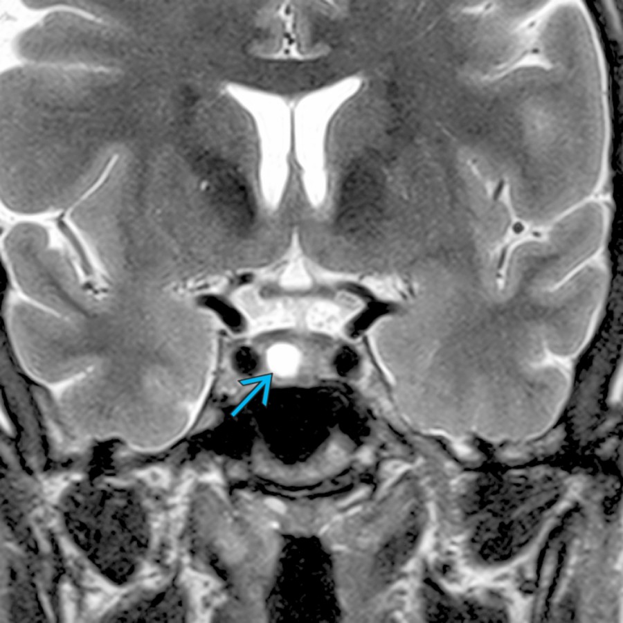 Coronal T2 MR shows a hyperintense intrasellar mass . Preoperative diagnosis was Rathke cleft cyst. An almost entirely cystic microadenoma was found at surgery.