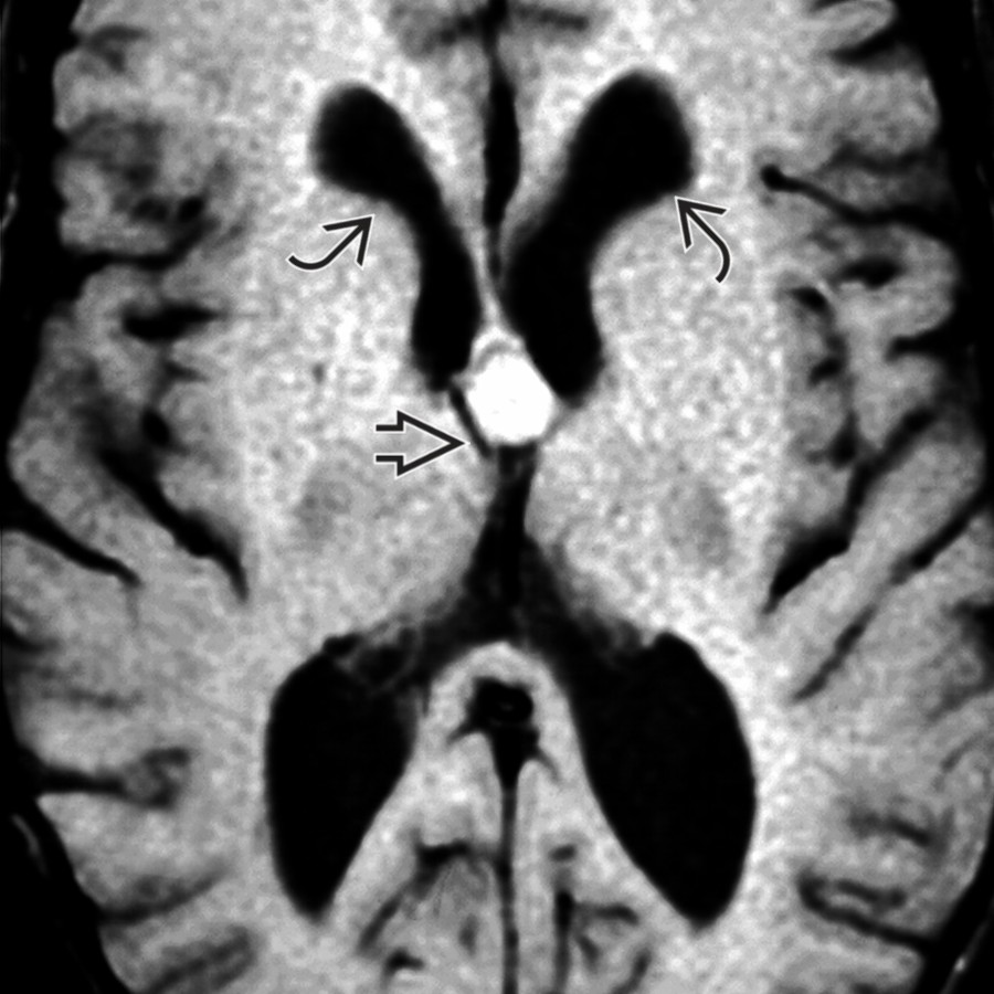 Axial T1WI MR shows a well-defined, hyperintense lesion  at the foramen of Monro in a patient with headaches, most consistent with a colloid cyst. Note the enlargement of the lateral ventricles  due to obstruction at the foramen of Monro.