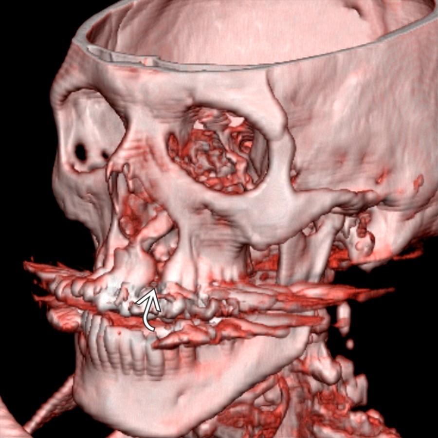 Oblique 3D reconstruction of the skull in the same patient shows a cleft palate . Other skeletal anomalies in this patient include fused ribs and hemi vertebra (not shown).