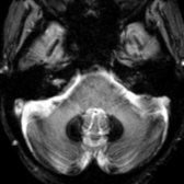 Axial T2* GRE MR in an adult with aceruloplasminemia (ACP) shows marked hypointensity related to iron deposition in the dentate nuclei  of cerebellum.