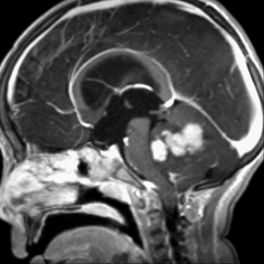 Sagittal T1 C+ MR shows nodular enhancement in this group 3 medulloblastoma, which has a poor outcome compared to other subgroups.