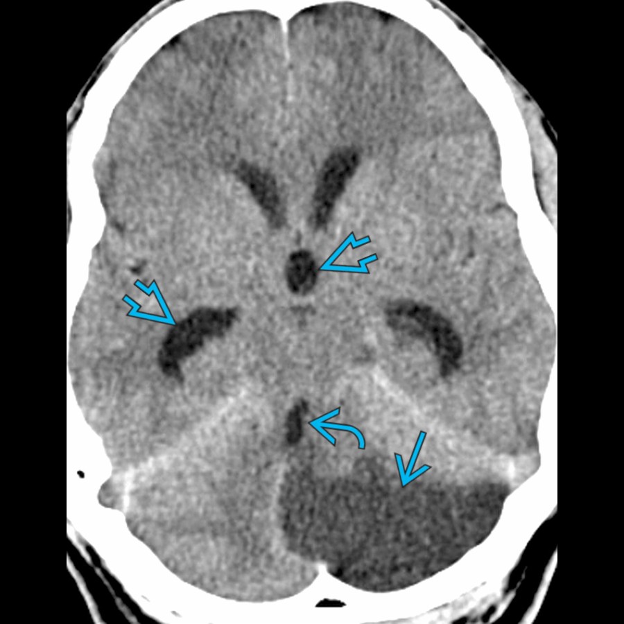 Axial CECT demonstrates a subacute left posterior inferior cerebellar infarct  causing mass effect on the 4th ventricle  and resulting in obstructive hydrocephalus .