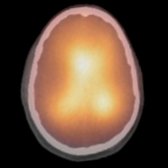 Axial fused radionuclide cisternography SPECT/CT in the same patient with NPH at 24 hours confirms activity in the lateral ventricles: Frontal horns  and occipital horns , consistent with NPH.