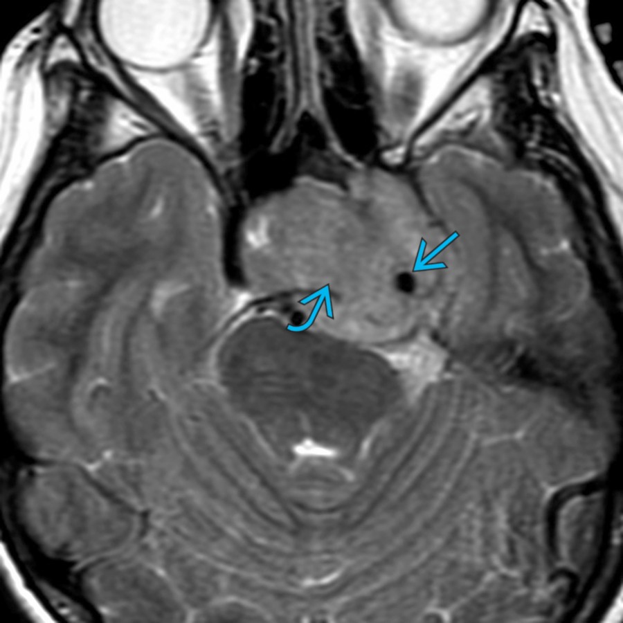 Axial T2 MR demonstrates a large, lobulated sellar/parasellar mass  with extension to the left cavernous sinus. Note encasement of the left cavernous carotid artery .