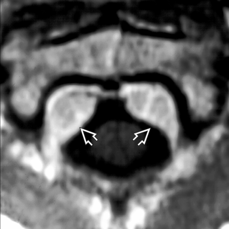 Axial T1WI C+ MR at the C2 level in a patient with spontaneous IH shows the draped curtain appearance of the markedly engorged epidural venous plexus . Brain MR (not shown) showed only mild dural enhancement.