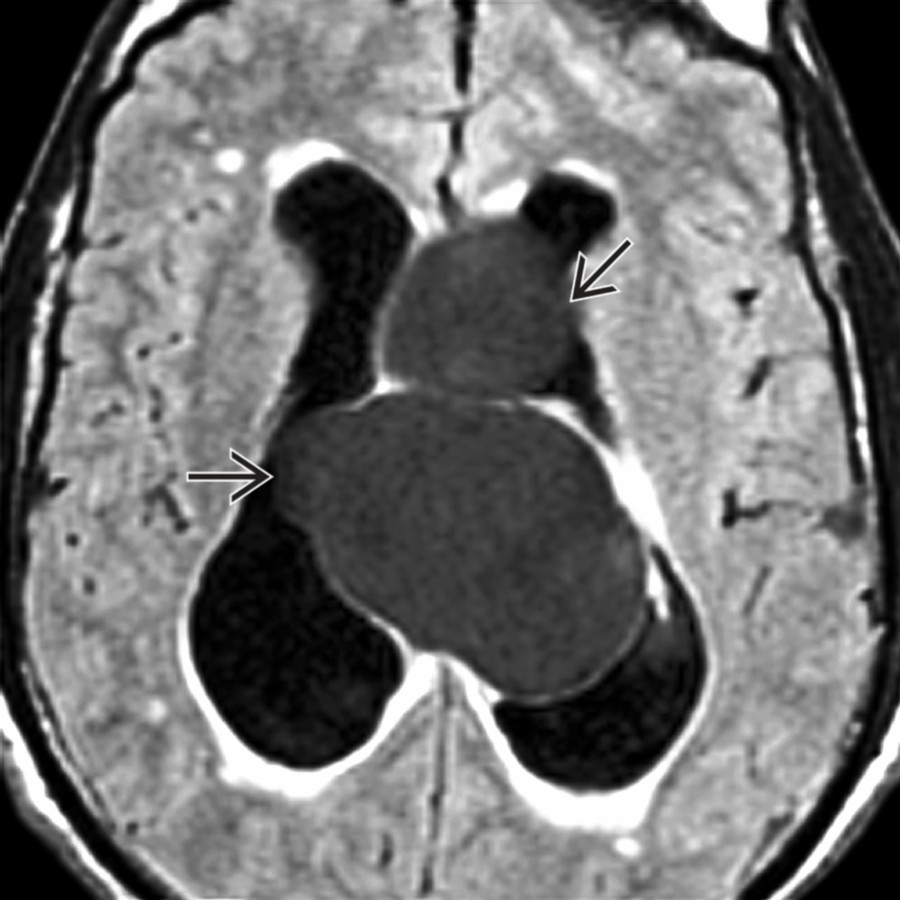 Axial FLAIR MR shows neurocysticercosis resulting in IVOH. Large intraventricular cysts are present in the lateral vents , obstructing the foramina of Monro.