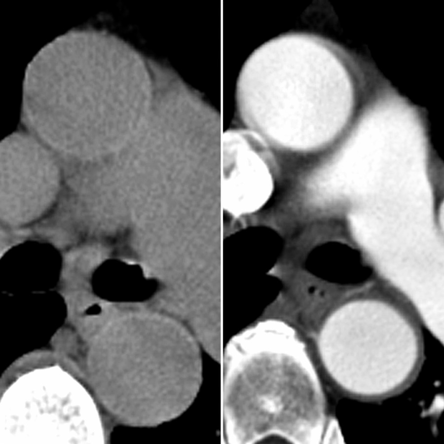 Axial NECT and CTA in the same patient show complete resolution of the IMH. IMH can resolve, remain stable, or progress to a variety of complications, including aortic dissection and rupture. CT remains the best follow-up tool for patients with type B IMH.