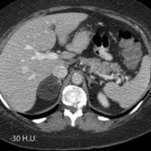 Axial CECT in the same patient shows a fat-attenuation right adrenal lesion . Macroscopic fat is the hallmark of myelolipomas, though the fat may be interspersed with soft tissue myeloid elements and hemorrhage.