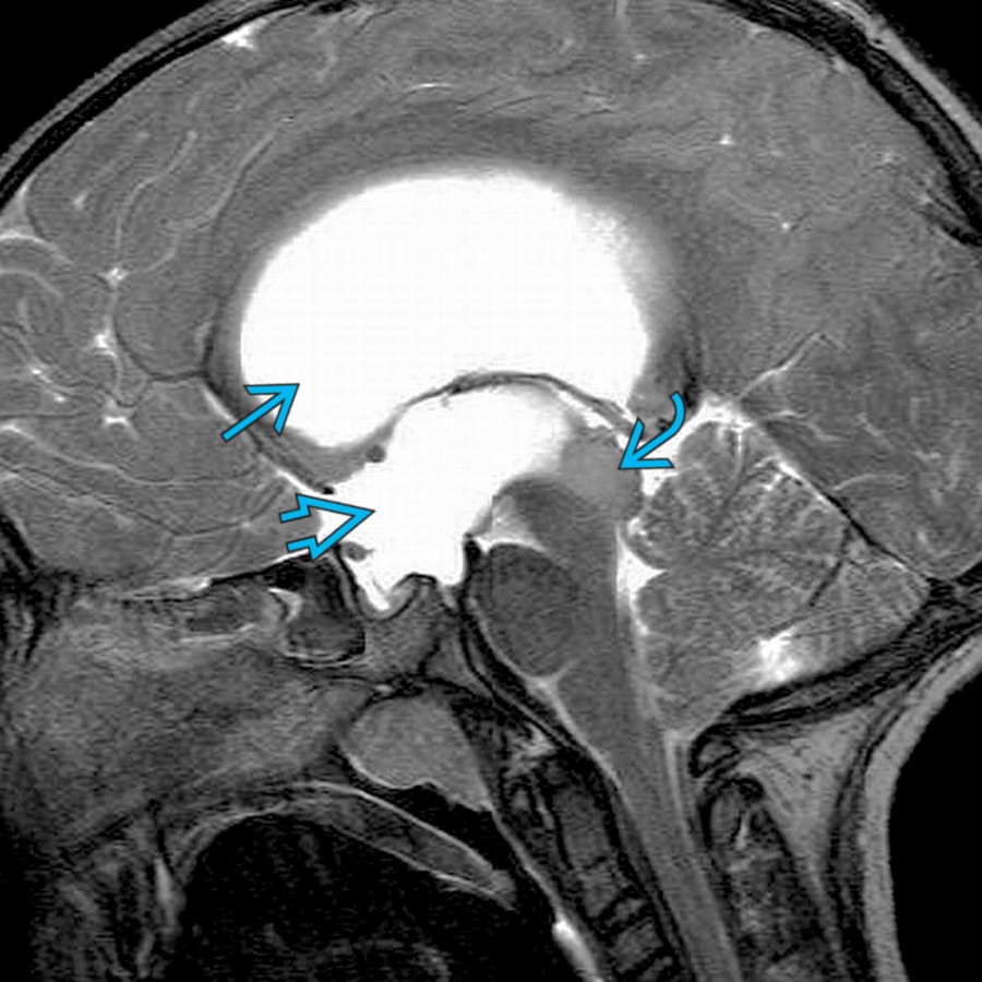 Sagittal T2 MR demonstrates an enlarged T2 hyperintense tectal plate glioma , which causes obstruction at the aqueduct and dilatation of the lateral  and 3rd ventricles .