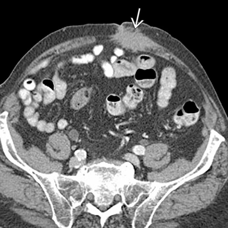 Axial CECT shows a hypodense mass   in the abdominal wall musculature, representing a metastasis from the patient's known colon cancer.