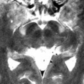 Axial T2WI MR in the same patient shows hyperintense CSTs  at the level of the cerebral peduncle. (Courtesy O.Q. Castro, MD.)
