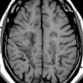 Axial T1 MR in a 34-year-old patient with longstanding, severe multiple sclerosis reveals multiple hypointense foci that are low signal and almost, but not quite, CSF-like. Note the faint, hyperintense rims  that surround some of the MS plaques. The T1 hypointensity correlates with axonal destruction.