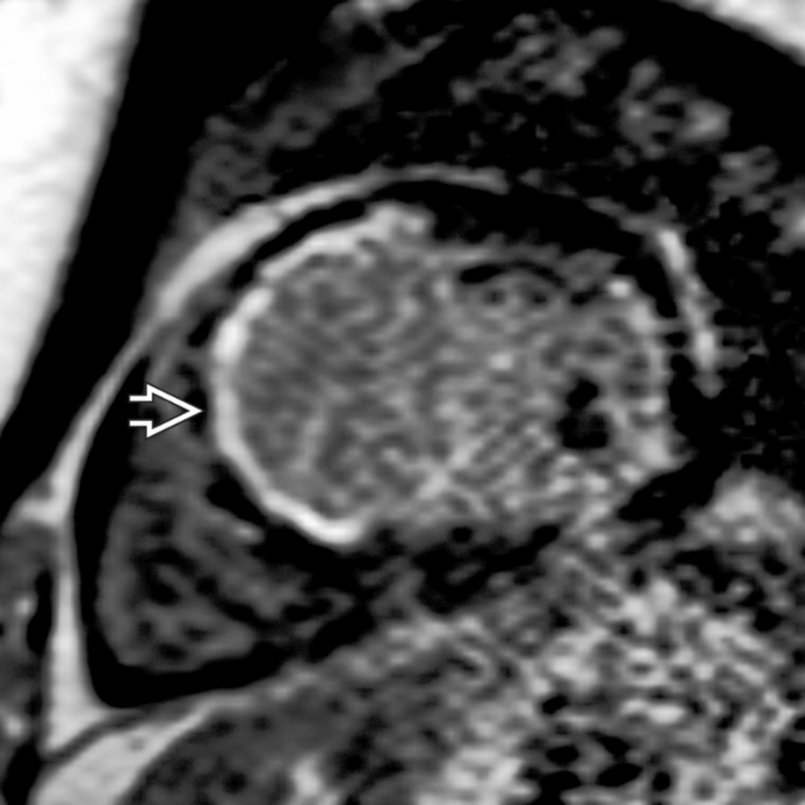 Short-axis inversion recovery MR through the LV mid-chamber shows dilated LV with late enhancement in a LAD distribution , compatible with ischemic cardiomyopathy.