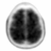 Axial F-18 florbetapir PET in a patient with MCI demonstrates homogeneous uptake throughout the brain without clear distinction between gray  and white matter , consistent with heavy β-amyloid (Aβ) deposition in the gray matter, which is seen in AD.
