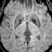 Axial SWI MR in a 76-year-old patient demonstrates horizontal linear "waves" of mineralization in the globus pallidi , a normal finding in the aging brain. There is less prominent hypointensity in the putamina due to iron deposition.