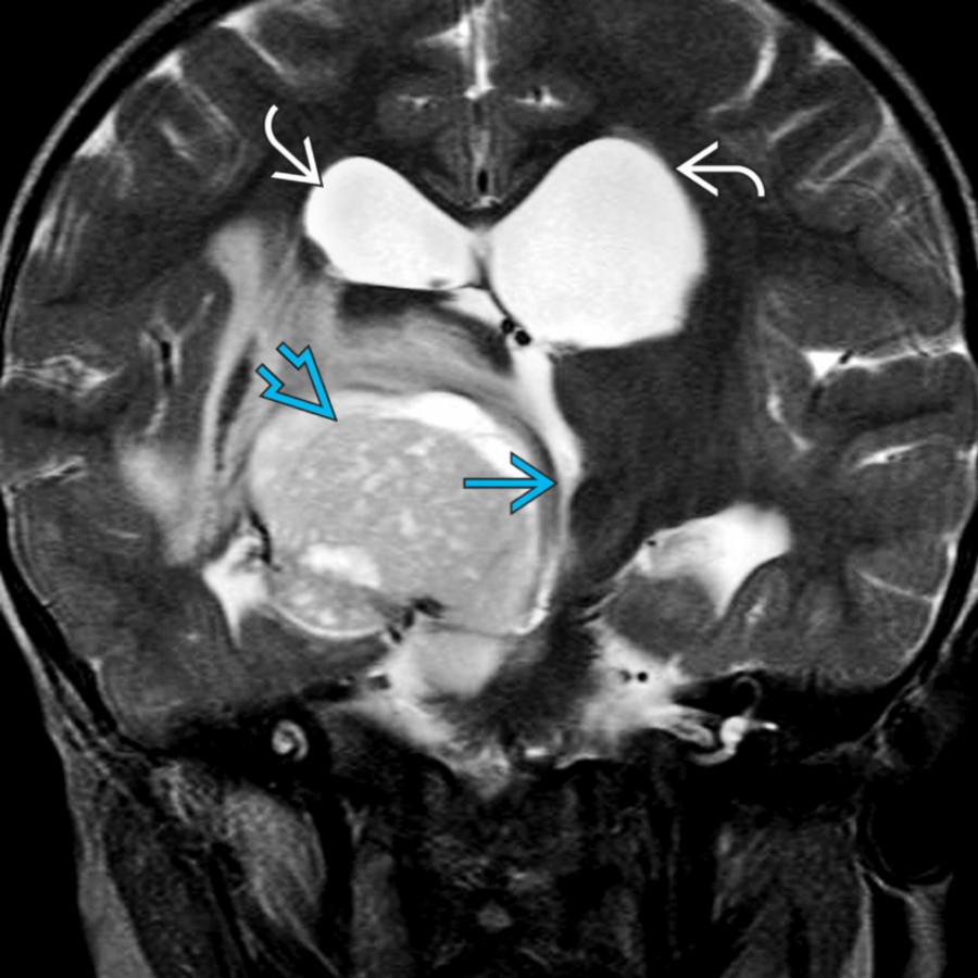 Coronal T2WI MR shows a pilocytic astrocytoma centered in the right thalamus  causing severe mass effect on the 3rd ventricle  and resultant obstructive hydrocephalus .