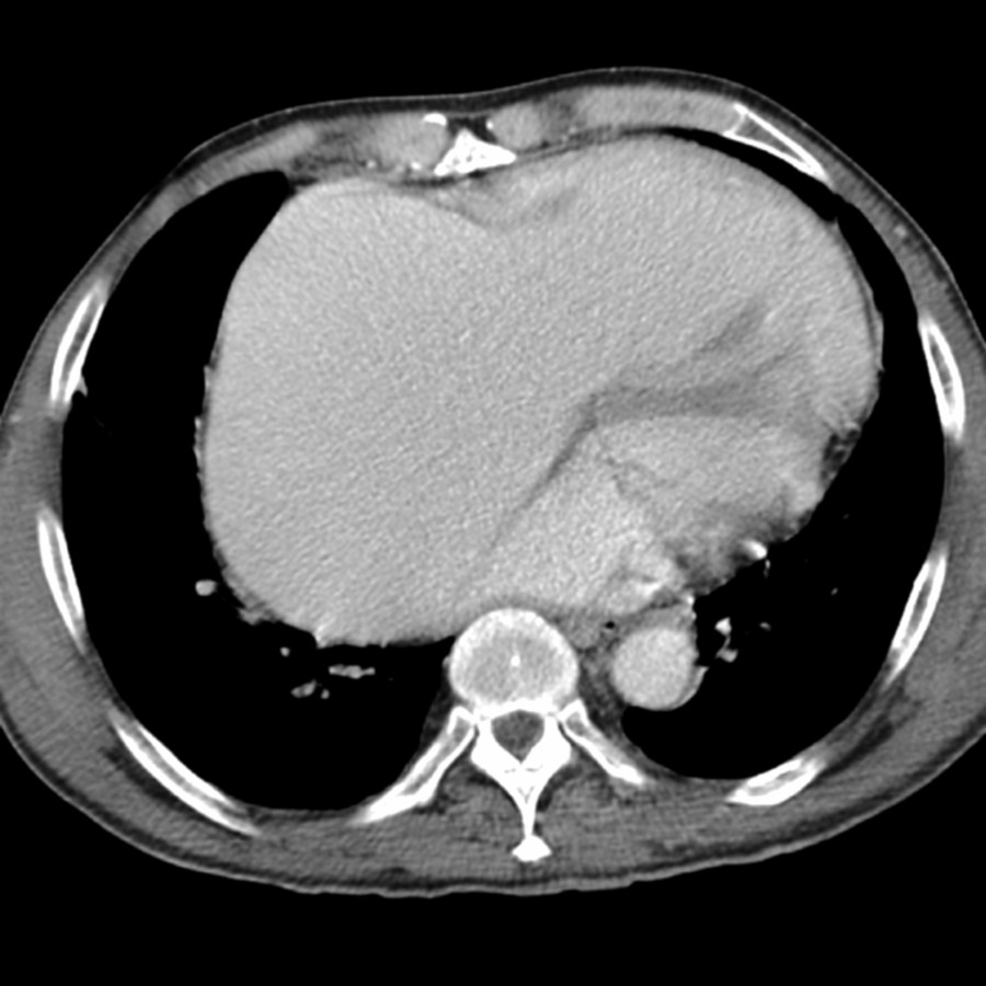 Axial CECT shows an enlarged right atrium in a patient with severe tricuspid regurgitation. Radiograph showed rightward deviation of the right heart border. Regurgitant jet was seen on MR.