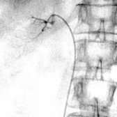 First of 2 images shows selective catheterization of the adrenal veins in a young woman with hyperaldosteronism, but no definite mass is seen on CT. Selective adrenal vein sampling was requested to assess unilateral excess aldosterone secretion. A catheter has been inserted through the right femoral vein, and the tip was advanced into the opening of the right adrenal vein. The adrenal veins are very fragile and could be easily ruptured by a forceful injection of contrast medium. The angiographer must know the vascular anatomy and gently probe the venous orifice, confirming the location with a small bolus injection of contrast medium, as shown here.