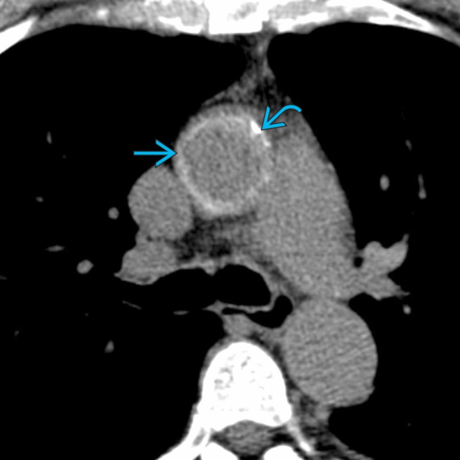 Axial NECT shows circumferential high attenuation in the ascending aorta  with an area of more dense calcification .