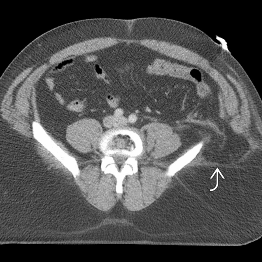 Axial NECT demonstrates a traumatic lumbar hernia in the setting of blunt trauma. The abdominal wall is disrupted in the left flank with herniated abdominal fat covered only by the latissimus dorsi muscle .