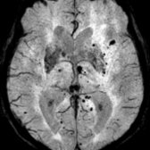 Axial SWI MR in the same patient demonstrates multiple scattered remote microhemorrhagic foci  bilaterally in both central and peripheral distribution.
