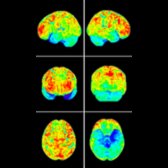 Brain surface map of F-18 FDG PET in a patient with svPPA demonstrates focal hypometabolism  in the anterior left temporal lobe. Notice how it is fairly localized to the anterior pole and asymmetric when compared to the contralateral side .
