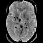 Axial SWI in the same patient shows multiple "blooming" hypointense foci due to remote microhemorrhages in the basal ganglia , thalami , and cerebral cortex . This patient had long-standing uncontrolled hypertension and the distribution of the microhemorrhages predominantly in the deep gray nuclei supports that.