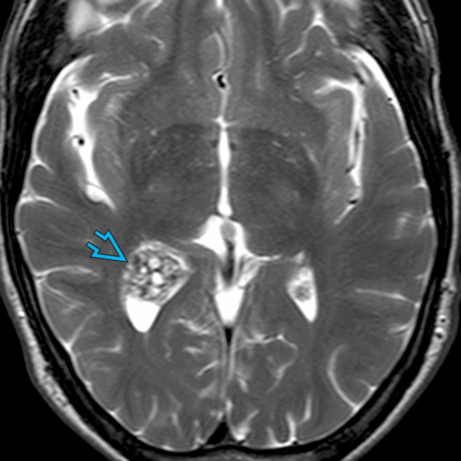 Axial T2 MR shows a heterogeneous right lateral ventricle mass  in a 58-year-old man. Subependymoma was found at resection. Imaging mimics a cavernous malformation.